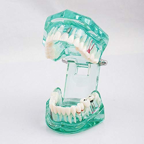 Alkita Prozirni zubi Model Izmjenjivi studij zuba za odrasle Model zuba Tipodont patološke bolesti Igrant nastavni