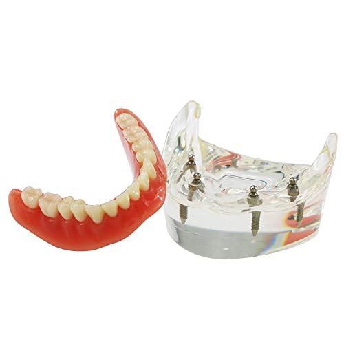 Dental Implant zuba Model M6003 Typodont Overdenture 4 implantata inferiorni niže restauracije Demo za proučavanje